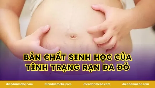 Bản chất sinh học của tình trạng rạn da đỏ
