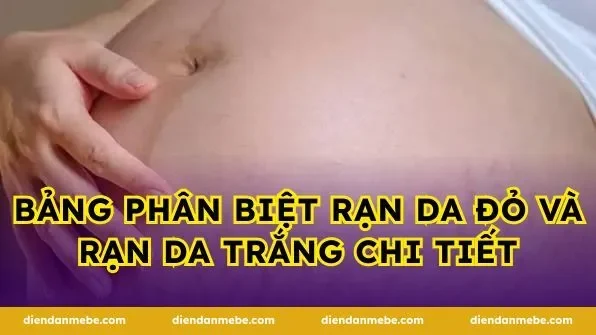 Bảng phân biệt rạn da đỏ và rạn da trắng chi tiết