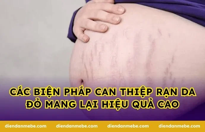Các biện pháp can thiệp rạn da đỏ mang lại hiệu quả cao