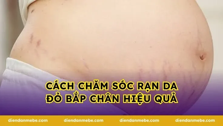 Cách chăm sóc rạn da đỏ bắp chân hiệu quả