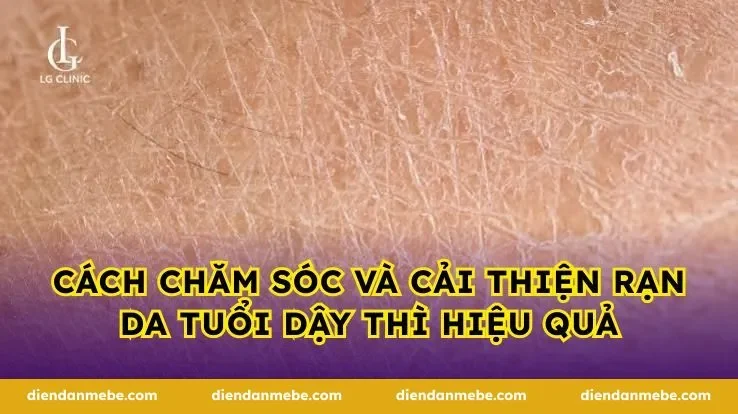 Cách chăm sóc và cải thiện rạn da tuổi dậy thì hiệu quả