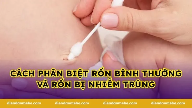 Cách phân biệt rốn bình thường và rốn bị nhiễm trùng