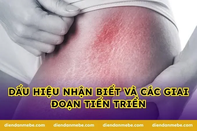 Dấu hiệu nhận biết và các giai đoạn tiến triển