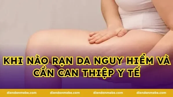 Khi nào rạn da nguy hiểm và cần can thiệp y tế
