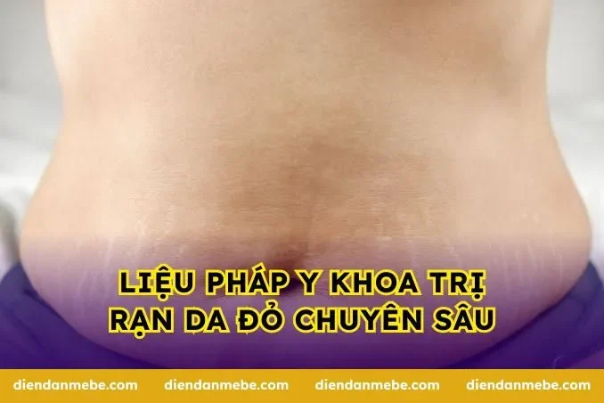 Liệu Pháp Y Khoa Trị Rạn Da Đỏ Chuyên Sâu