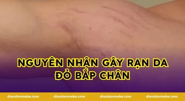 Nguyên nhân gây rạn da đỏ bắp chân
