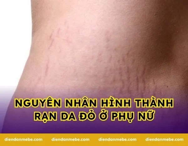Nguyên Nhân Hình Thành Rạn Da Đỏ Ở Phụ Nữ