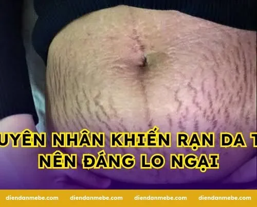 Nguyên nhân khiến rạn da trở nên đáng lo ngại