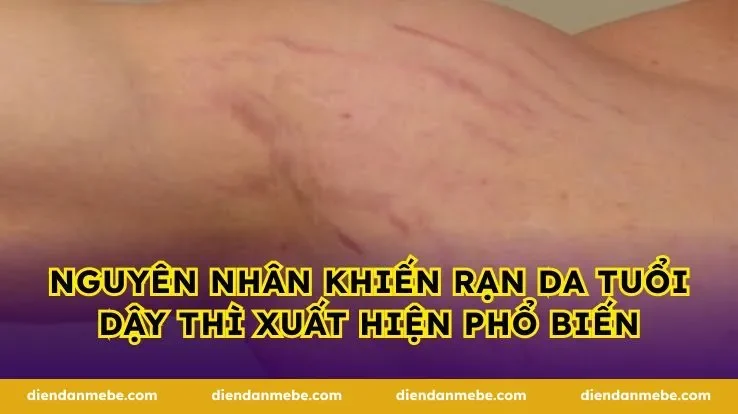 Nguyên nhân khiến rạn da tuổi dậy thì xuất hiện phổ biến