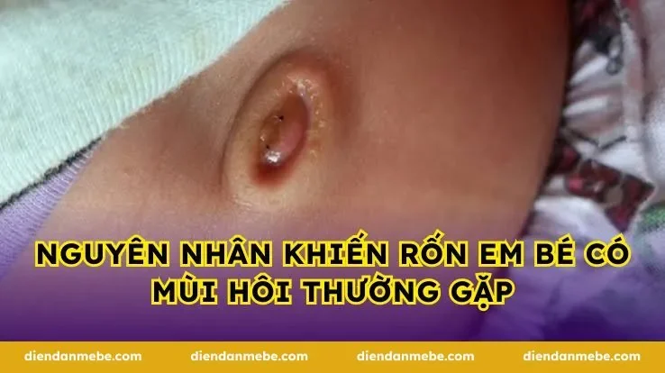 Nguyên nhân khiến rốn em bé có mùi hôi thường gặp