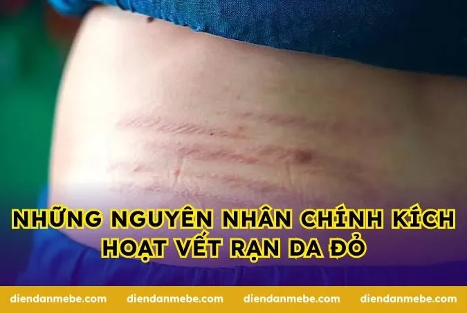 Những nguyên nhân chính kích hoạt vết rạn da đỏ