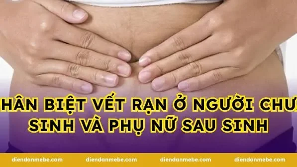 Phân biệt vết rạn ở người chưa sinh và phụ nữ sau sinh