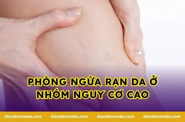 Phòng ngừa rạn da ở nhóm nguy cơ cao