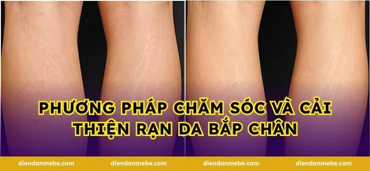 Phương pháp chăm sóc và cải thiện rạn da bắp chân