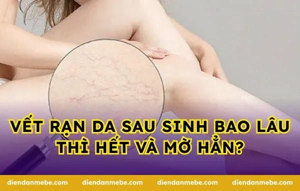 Vết rạn da sau sinh bao lâu thì hết và mờ hẳn?
