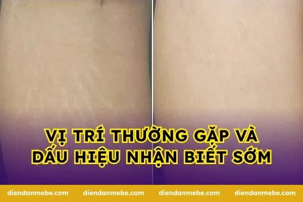 Vị trí thường gặp và dấu hiệu nhận biết sớm